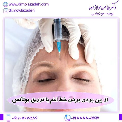 تزریق بوتاکس
