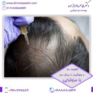 درمان ریزش مو با مزوتراپی