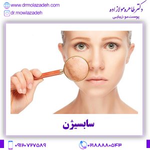 سابسیژن