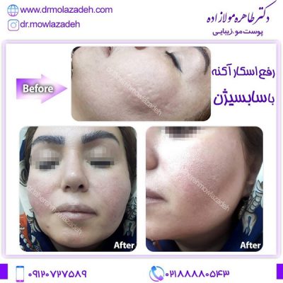 سابسیژن