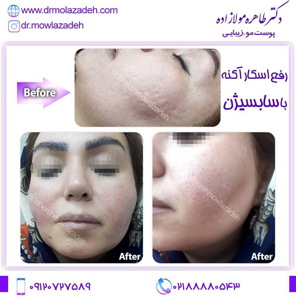 سابسیژن