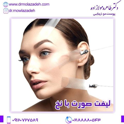 لیفت صورت با نخ