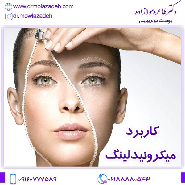 میکرونیدلینگ