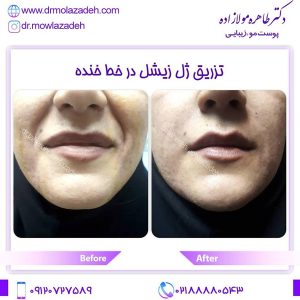 مراقبت های بعد از تزریق ژل