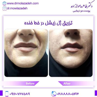 مراقبت های بعد از تزریق ژل