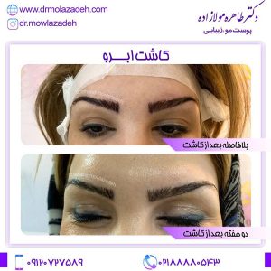 کاشت ابرو