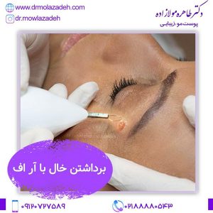 برداشتن خال