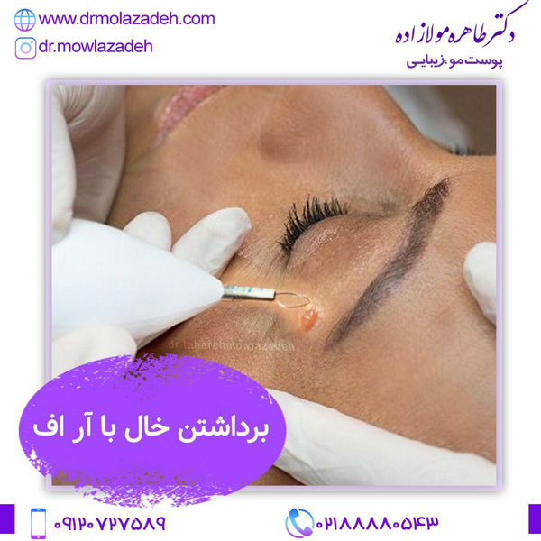 برداشتن خال