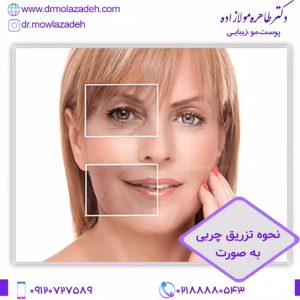 تزریق چربی به صورت
