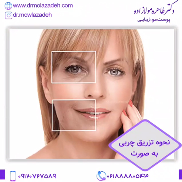 تزریق چربی به صورت