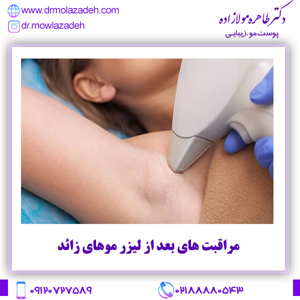 مراقبت های بعد از لیزر موهای زائد
