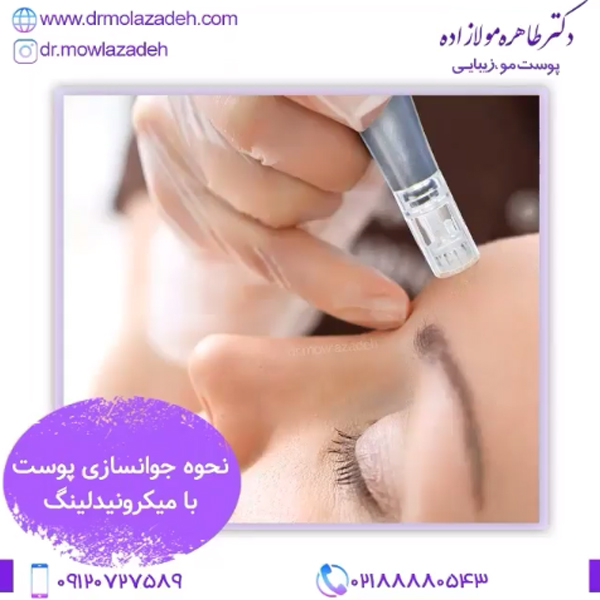 مراقبت های بعد از میکرونیدلینگ