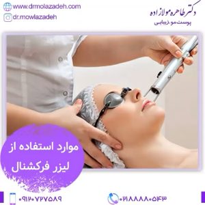 لیزر فرکشنال