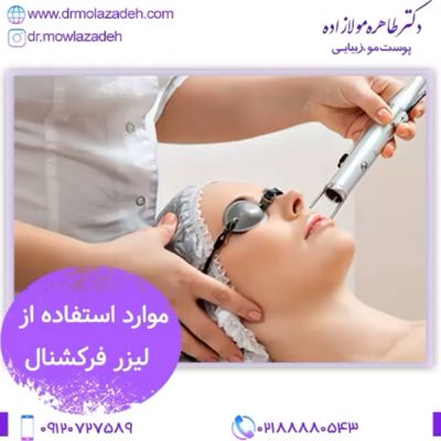 لیزر فرکشنال
