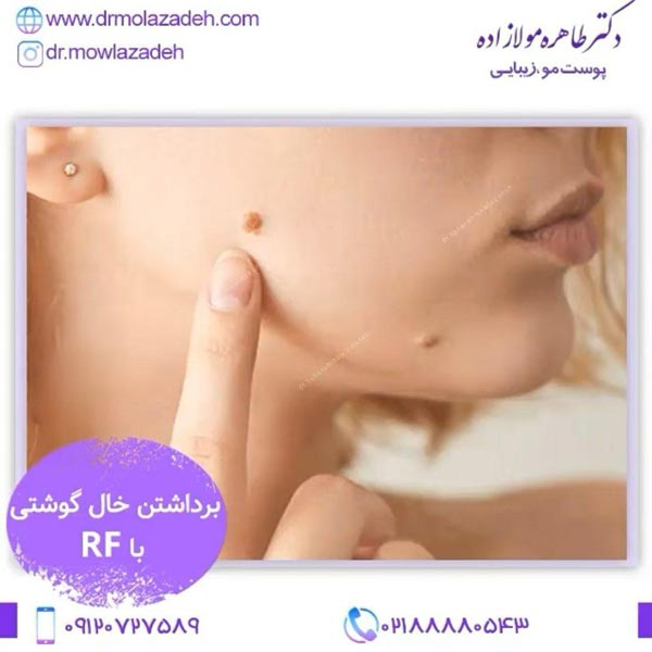 آر اف فرکشنال