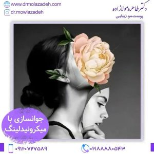 میکرونیدلینگ
