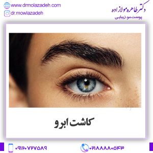 کاشت ابرو