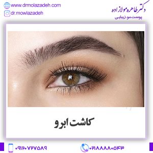کاشت ابرو