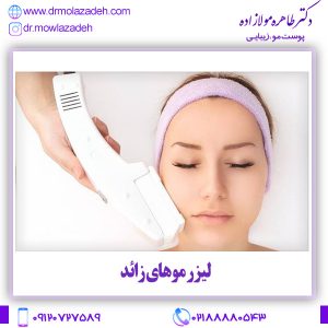 لیزر موهای زائد
