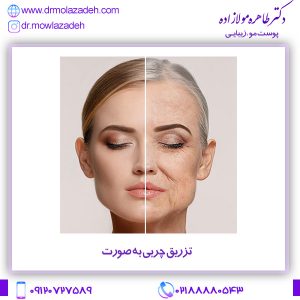 تزریق چربی به صورت