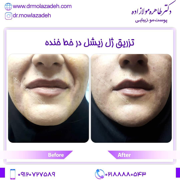 تزریق ژل