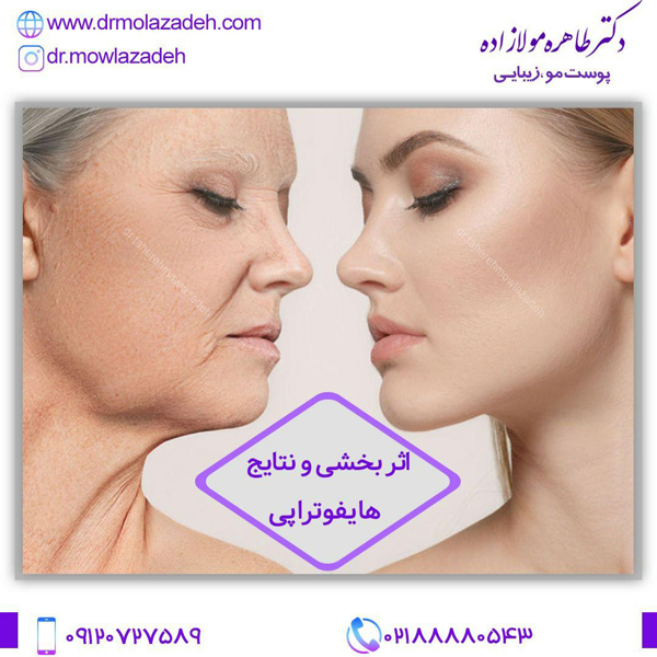 هایفوتراپی