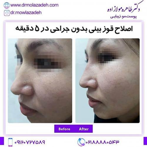 اصلاح-قوز-بینی-1