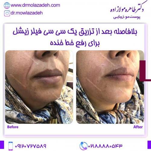 تزریق-فیلر-زیشل-برای-خط-خنده