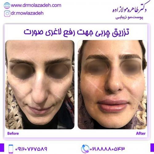تزریق-چربی-جهت-رفع-لاغری-صورت