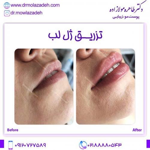 تزریق-ژل-لب