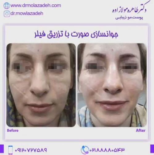 جوانسازی-صورت-با-تزریق--فیلر