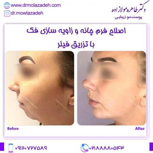 زاویه-سازی-فک-و-چانه-1