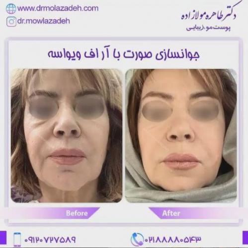 جوانسازی-صوزت-با-آر-اف-ویواسه-1