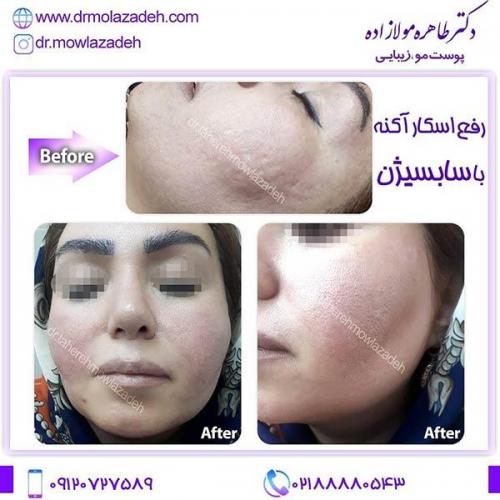سابسیژن