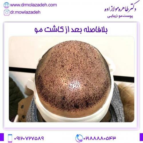 کاشت-مو-1